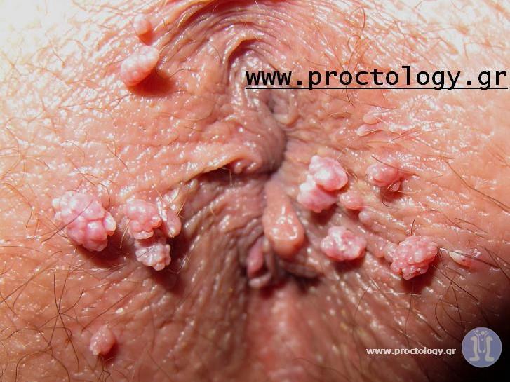 anal warts picture.