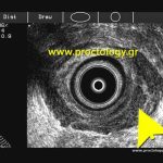 perianal abscess, endoanal ultrasound, περιεδρικό απόστημα